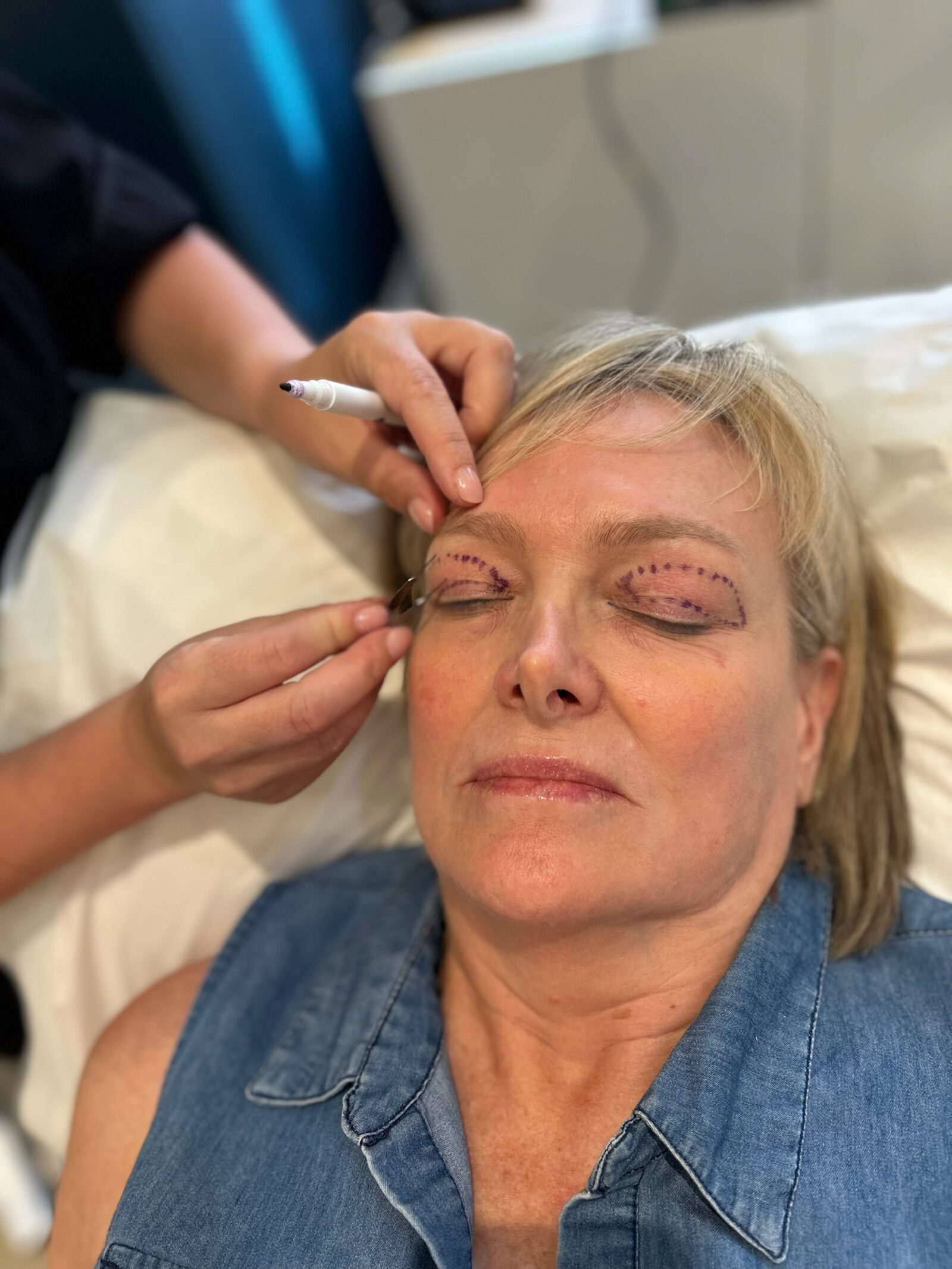 Pre-operative eyelid marking at Cove Lodge Clinic